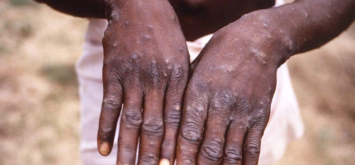 Chickenpox Outbreak Causes Concern in Wubara Community, Abuja
