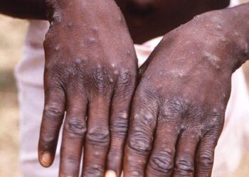 Chickenpox Outbreak Causes Concern in Wubara Community, Abuja