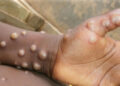 Africa CDC Declares Mpox Outbreak a Continental Public Health Emergency