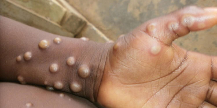 Africa CDC Declares Mpox Outbreak a Continental Public Health Emergency